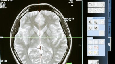 Choroba Parkinsona to coraz większe zagrożenie. Choruje już prawie 100 tysięcy osób
